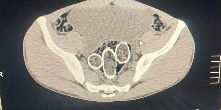 320 gram uyuşturucuyu mide ve rahme sakladılar