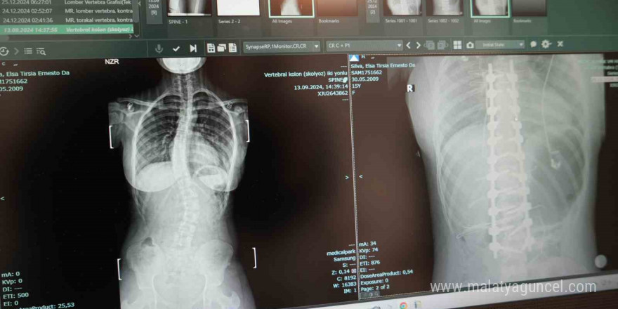 Afrikalı Elsa, omurgasındaki 45 derece eğrilikten Samsun’da kurtuldu