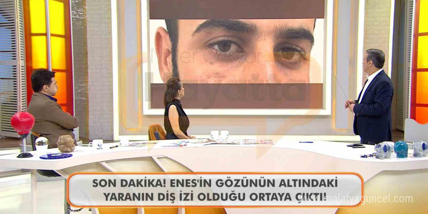 Canlı yayında Enes Güran’ın gözünün altındaki diş izine dikkat çekildi